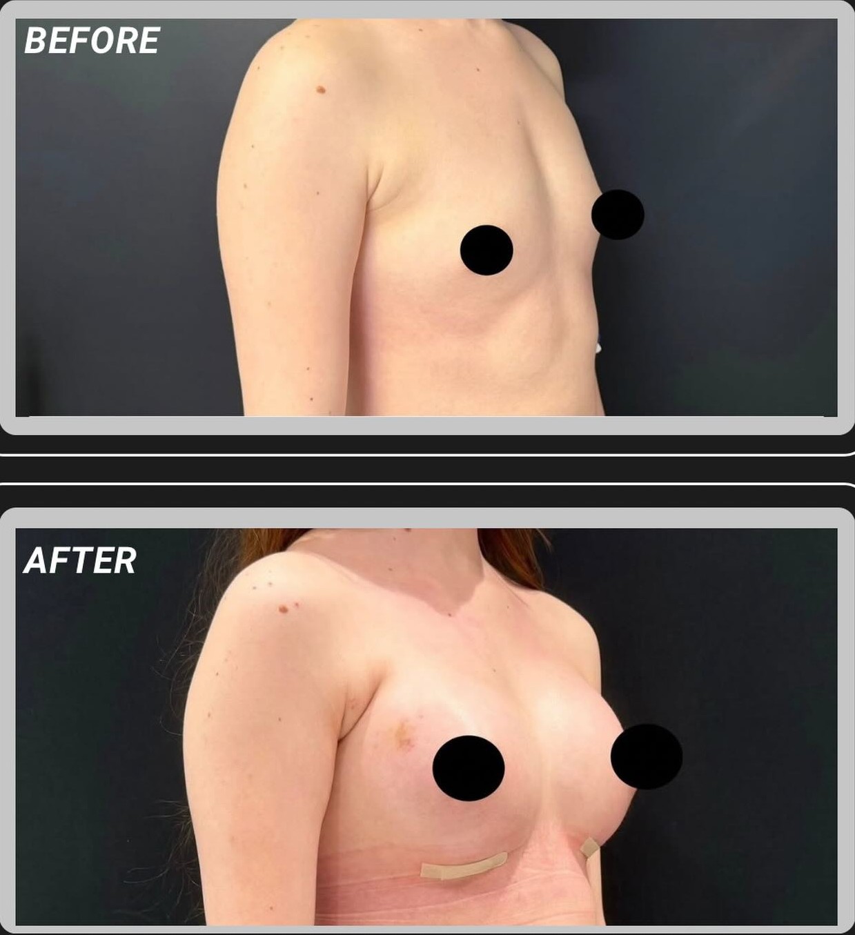 Breast Implant Before and After Result 2
